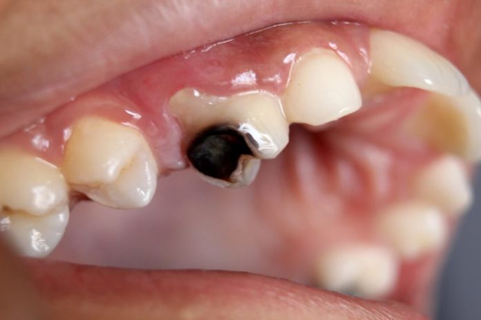 Dental_Caries_Cavity_2